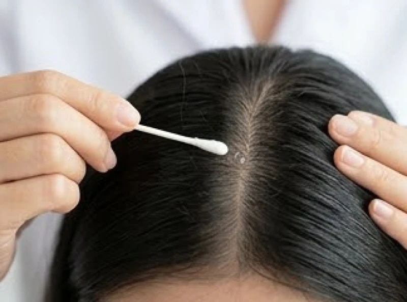 Dùng tăm bông sạch để chấm một lớp mỏng thuốc mỡ lên vết thương trên da đầu