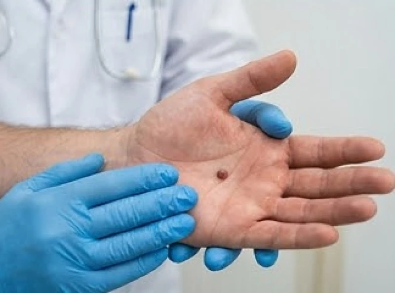 Bác sĩ da liễu khám trực tiếp nốt ruồi lồi ở lòng bàn tay để đưa ra phác đồ chuẩn