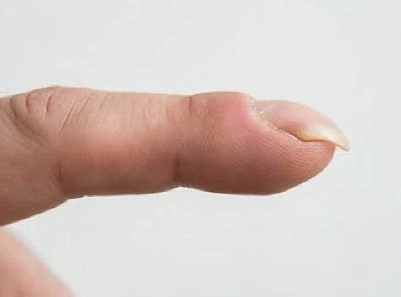 Cấu trúc bất thường của đầu ngón tay dùi trống với phần móng cong gập xuống