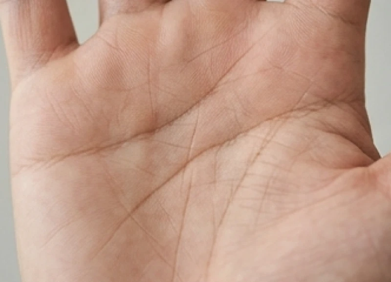 Khu vực lòng bàn tay xuất hiện đường nếp gấp ngang kèm theo những nhánh nhỏ tàn dư hướng lên trên các ngón