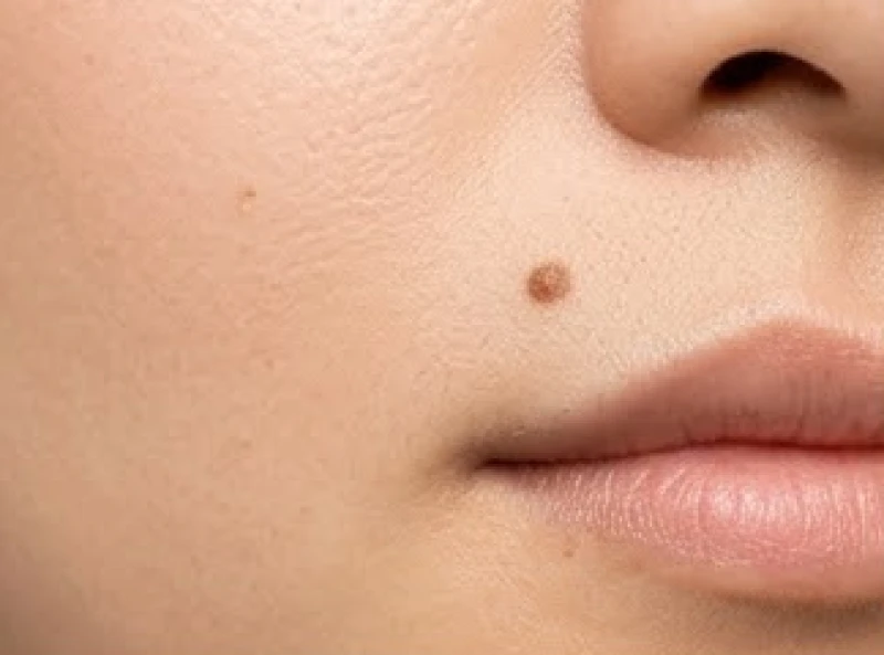 Nốt ruồi dưới mũi: Ý nghĩa tướng số nam nữ & vị trí nhân trung 1 Sự tích tụ tế bào hắc tố melanin hình thành nốt ruồi dưới mũi khi tiếp xúc tia UV