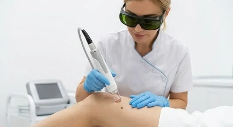Quá trình thực hiện tẩy nốt ruồi bằng công nghệ laser CO2 tại phòng khám