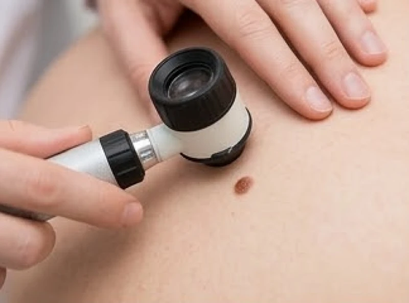 Bác sĩ da liễu soi cấu trúc một nốt ruồi lành tính trên da mỏng để kiểm tra màu sắc và kích thước