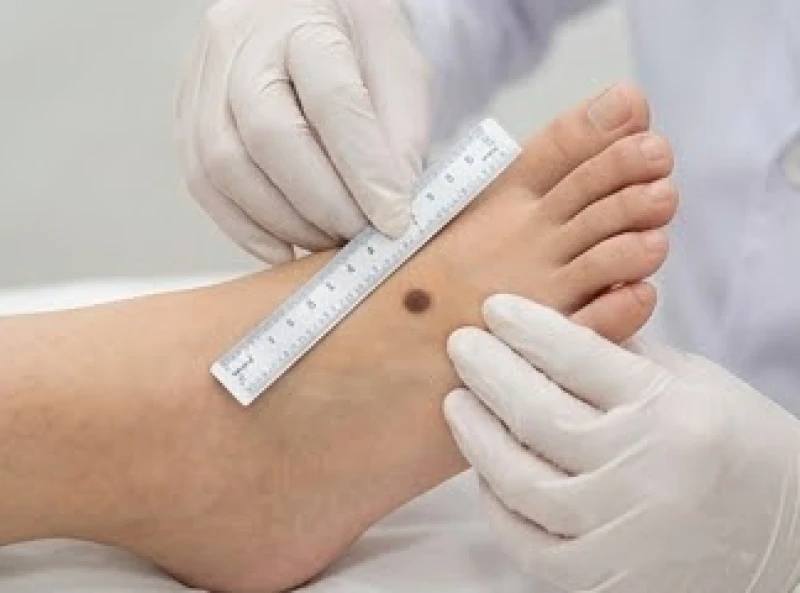 Bác sĩ đang dùng thước chuyên dụng đo kích thước và đường viền nốt ruồi để tầm soát ung thư tế bào