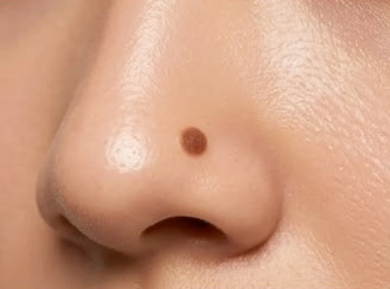 So sánh hình thái nốt ruồi bình thường với bề mặt trơn láng và viền tròn sắc nét trên da