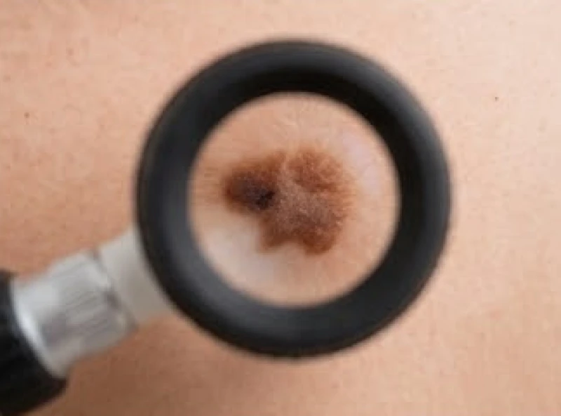 Nốt ruồi ở nách: Ý nghĩa tướng số, y khoa và chi phí tẩy laser 6 Kính lúp soi da chuyên dụng được dùng để phóng to bề mặt nốt ruồi bất thường vùng nách