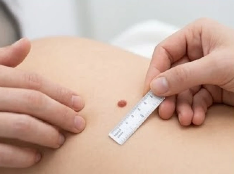 Bác sĩ dùng thước kẻ y tế chuyên dụng để đo chính xác đường kính nốt ruồi trên da