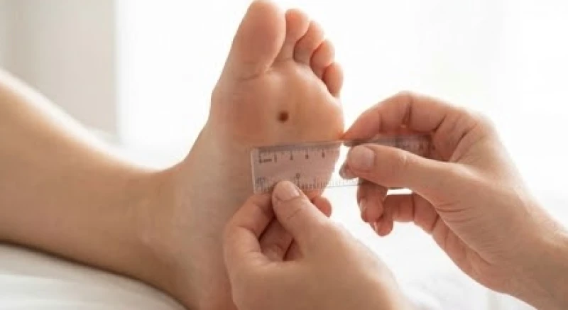 Dùng thước nhỏ để đo đường kính nốt ruồi ở lòng bàn chân trái nữ nhằm đối chiếu với tiêu chuẩn an toàn y tế 6mm