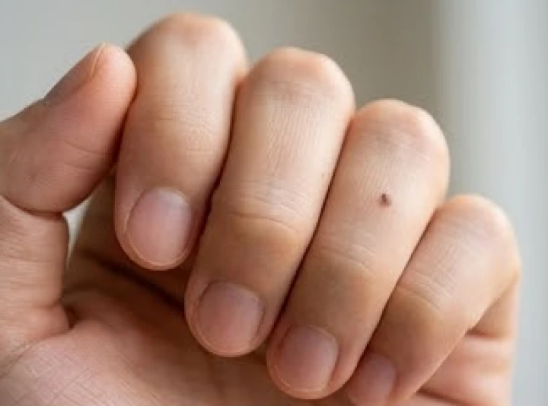 Bàn tay nắm nhẹ với một nốt ruồi nhỏ xuất hiện rõ nét ở đốt thứ hai của ngón tay