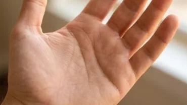 Bàn tay mở rộng để lộ rõ đường hôn nhân bị đứt gãy dưới gốc ngón út