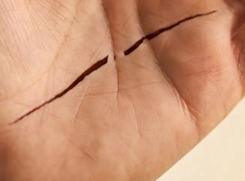 Vết đứt gãy nằm ngay giữa đường chỉ tay tạo ra một khoảng trống nhỏ trên da trước khi tiếp tục kéo dài