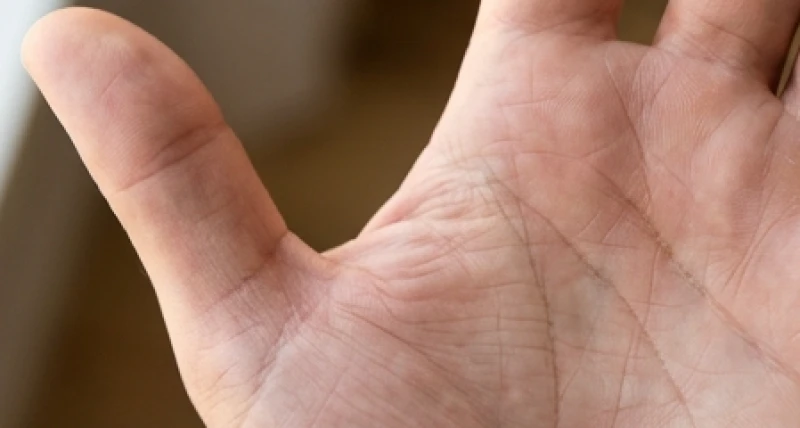 Đường chỉ tay mờ và rối: Ý nghĩa vận mệnh và góc nhìn y khoa 3 Quan sát đường sinh đạo bao quanh gò Kim Tinh bị mờ và đứt đoạn thành nhiều khúc đứt gãy nhỏ.