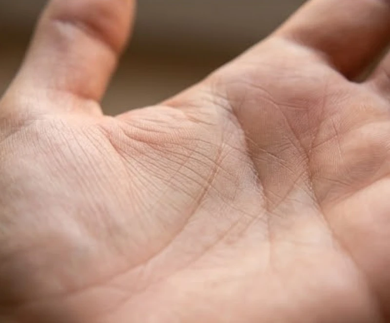 Vết hằn đường hỏa tinh mờ nhạt và đứt gãy thành nhiều đoạn nhỏ nằm sát gốc ngón tay cái