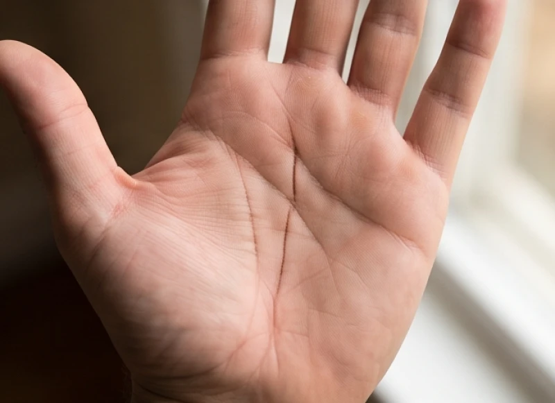 Bàn tay có nếp gấp dọc bị đứt thành hai đoạn rõ rệt ở giữa lòng bàn tay