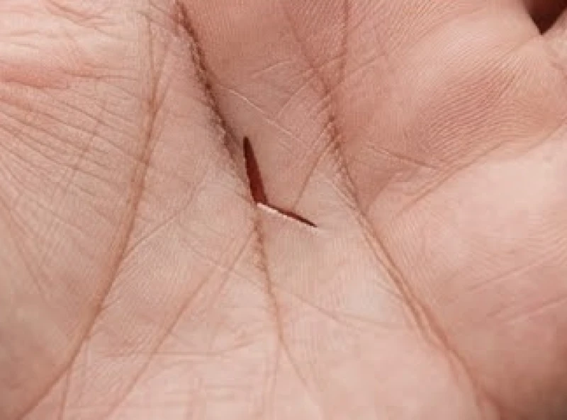 Đường trí đạo hình dây xích: Giải mã ý nghĩa và cách hóa giải 8 Cấu trúc đường trí đạo bị đứt đoạn rõ nét ngay trên lòng bàn tay