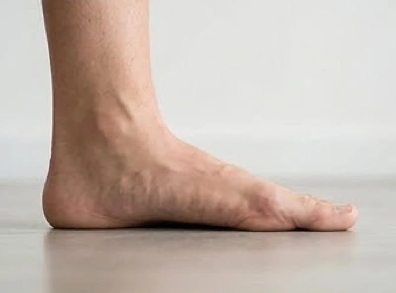 Lòng bàn chân sụp vòm hoàn toàn tiếp xúc sát mặt sàn gây mất thăng bằng khi di chuyển