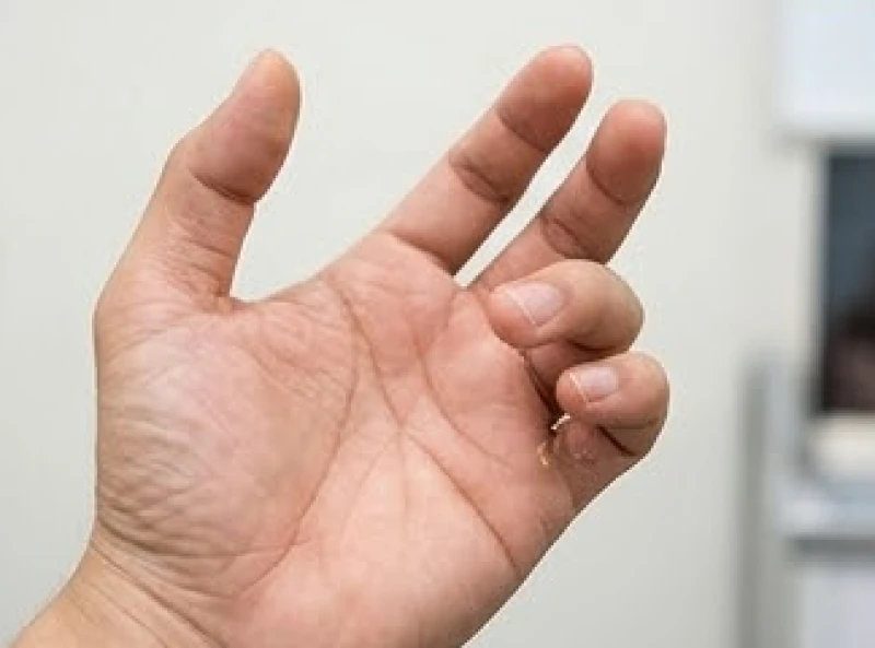 Ngón út không chạm đốt ngón áp út: Tướng số và phân biệt y khoa 9 Ngón út bị gập cong và kẹt cứng do hội chứng ngón tay cò súng gây viêm bao gân
