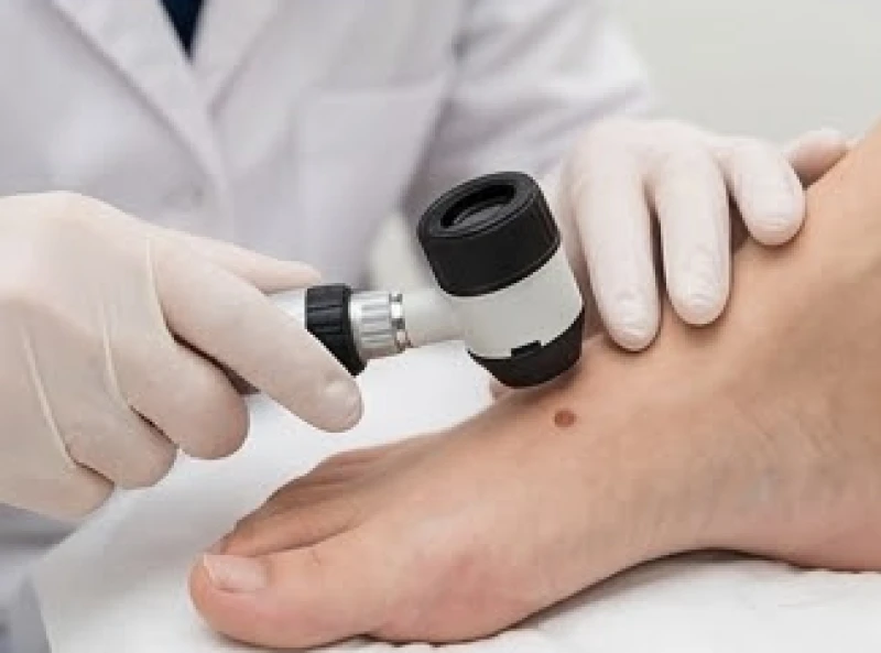 Bác sĩ da liễu sử dụng kính lúp chuyên dụng kiểm tra cẩn thận nốt ruồi trên mu bàn chân