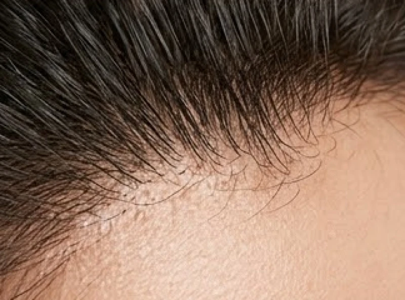 Cấu trúc nang tóc mọc sát bề mặt mép viền da đầu khỏe mạnh
