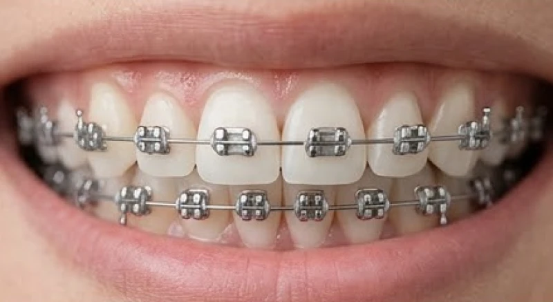 Cận cảnh hàm răng đang được gắn mắc cài kim loại và dây cung niềng răng để nắn chỉnh