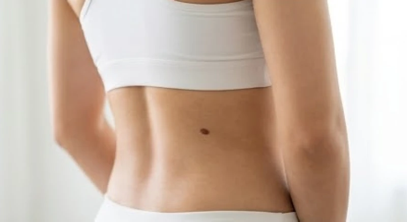 Nốt ruồi sau lưng: Ý nghĩa tướng số nam nữ và đánh giá an toàn 4 Nốt ruồi nổi bật mọc ở hai bên mạn sườn sau lưng của một cô gái