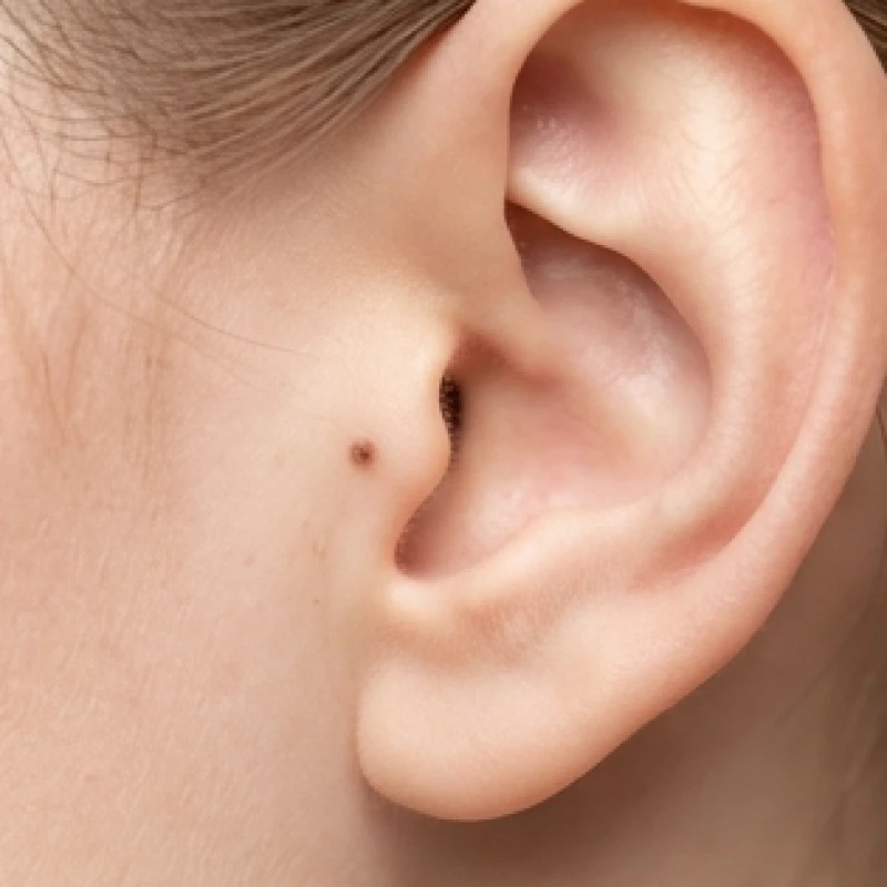 Nốt ruồi ở tai nữ: Giải mã ý nghĩa phong thủy và góc nhìn y khoa 4 Phần sụn cuống tai nhô ra phía trước có nốt ruồi thể hiện tính cách cẩn trọng và sắc bén