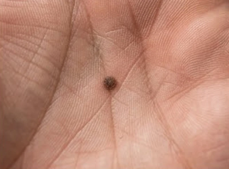 Cụm hắc sắc tố melanin hình thành nốt ruồi đen chìm dưới da lòng bàn tay
