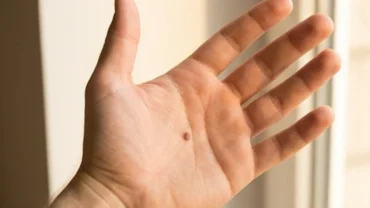 Cận cảnh nốt ruồi sắc nét giữa lòng bàn tay dưới ánh sáng tự nhiên