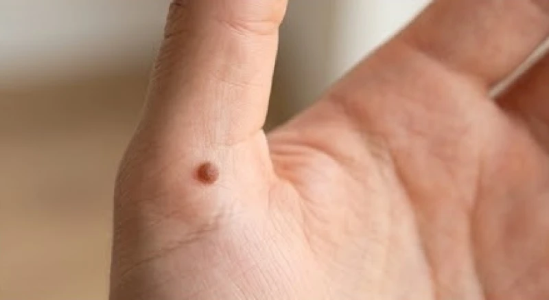 Nốt ruồi đen nằm ở phần gốc ngón tay cái ngay điểm tiếp giáp với bàn tay