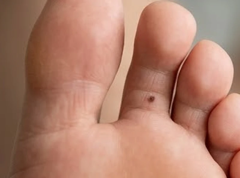 Chấm sắc tố nhỏ ẩn giấu kín đáo ở kẽ giữa ngón chân cái và ngón trỏ của bàn chân