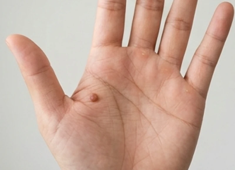 Bàn tay mở rộng để lộ một nốt ruồi thịt nằm ngay dưới gốc ngón trỏ