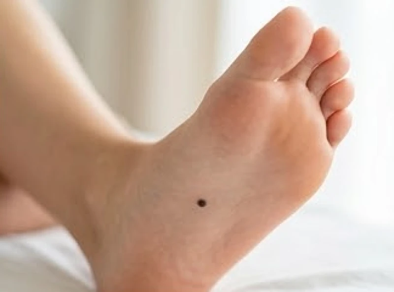 Nốt ruồi đen nhỏ nằm ẩn dưới lòng bàn chân của một người trưởng thành