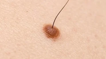 Nốt ruồi mọc lông khỏe mạnh trên làn da với kích thước nhỏ gọn và màu sắc đồng nhất