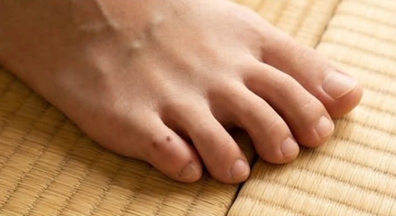 Đốm nốt ruồi nhỏ xuất hiện trên ngón chân út ở khu vực rìa ngoài của bàn chân