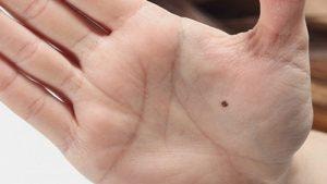 Nốt ruồi ở lòng bàn tay