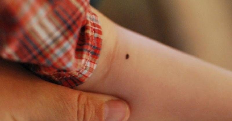 Ý nghĩa của nốt ruồi ở khuỷu tay