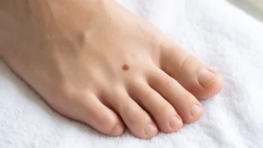 Nốt ruồi ở kẽ ngón chân khỏe mạnh với màu sắc đồng nhất và đường viền sắc nét trên nền da sáng màu