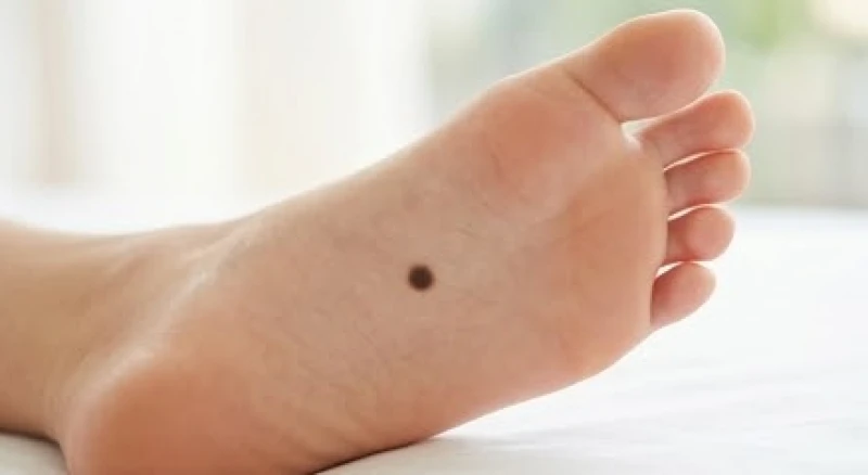 Nốt ruồi phú quý hiếm gặp: Bản đồ tọa độ và tiêu chí nhận diện 6 Lòng bàn chân có nốt ruồi mọc trọn vẹn bên dưới đại diện cho đường công danh rạng rỡ của người phụ nữ