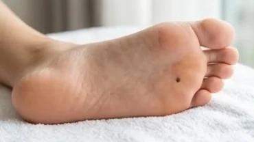 Cận cảnh nốt ruồi ở lòng bàn chân khỏe mạnh với màu sắc đồng đều và bờ viền rõ nét