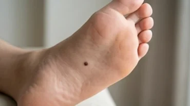 Nốt ruồi ở lòng bàn chân phải với màu sắc đồng nhất trên nền da khỏe mạnh