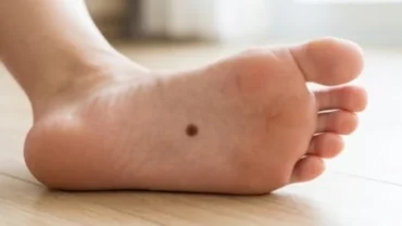 Cận cảnh nốt ruồi ở lòng bàn chân trái hiện rõ trên làn da sáng khỏe mạnh