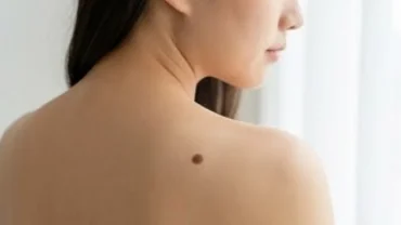 Một nốt ruồi ở lưng bên phải có kích thước nhỏ và màu nâu nhạt nổi bật trên làn da của người phụ nữ