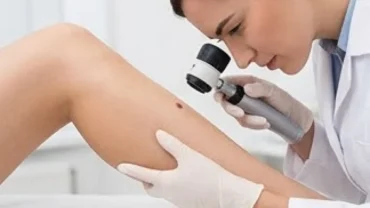 Bác sĩ da liễu đang khám nốt ruồi ở phần thân dưới bằng ống kính lúp chuyên dụng