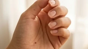 Cận cảnh bàn tay của một người với nốt ruồi rõ nét, thể hiện đặc điểm nốt ruồi ở tay trong nhân tướng học