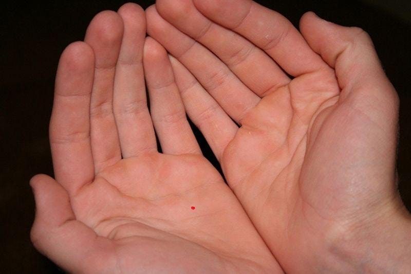 Ý nghĩa của nốt ruồi phú quý trên lòng bàn tay