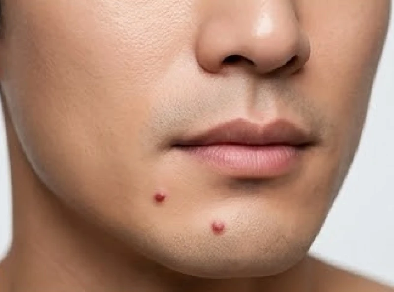 Nốt ruồi ở cằm trái nam: luận tướng số và tiêu chí tẩy an toàn 6 Cận cảnh nốt ruồi son đỏ may mắn ở cằm trái của nam giới mang lại nhiều tài lộc