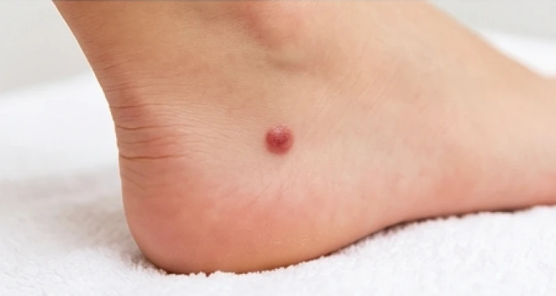 Nốt ruồi son màu đỏ hồng rực rỡ mọc ở gót chân mang lại nhiều may mắn và tài lộc