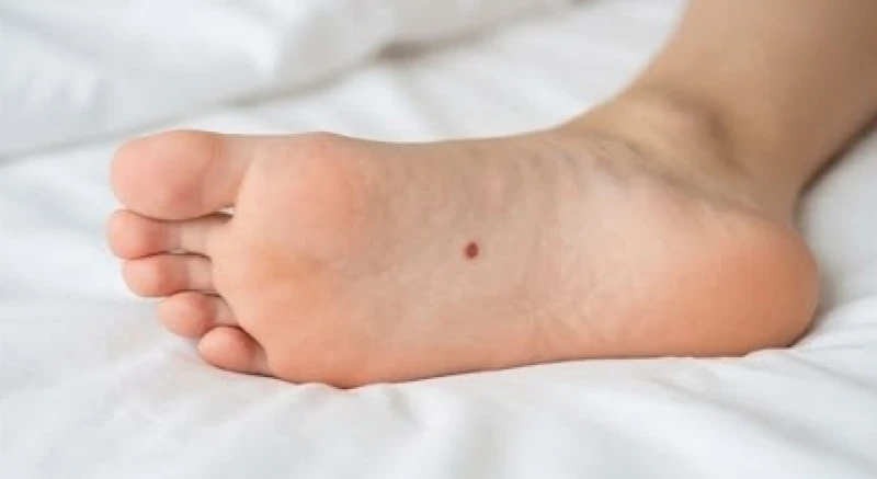 Nốt ruồi son đỏ mọc tại gan bàn chân của người phụ nữ, mang ý nghĩa tài lộc vượng phát trong phong thủy phương Đông