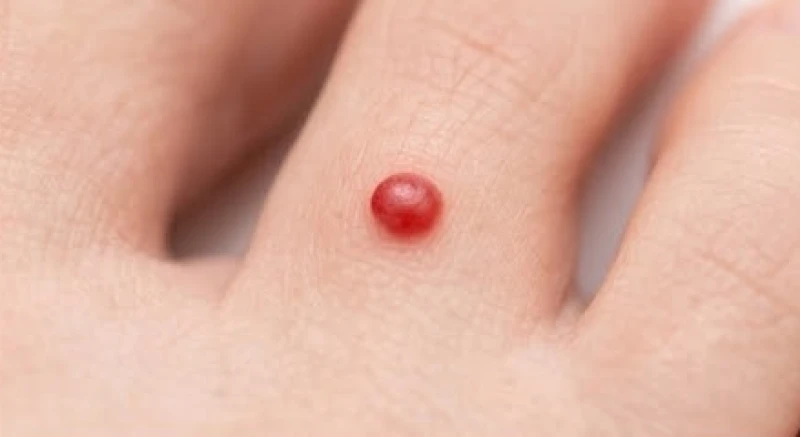 Một nốt ruồi son màu đỏ hồng lành tính nổi bật trên vùng da ngón chân sáng màu