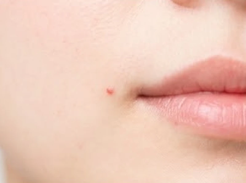 Nốt ruồi ở mép: Ý nghĩa tướng số, dấu hiệu y khoa & chi phí tẩy 5 Một nốt ruồi son màu đỏ nhạt xuất hiện quanh khu vực mép miệng tượng trưng cho sự may mắn và hỷ sự